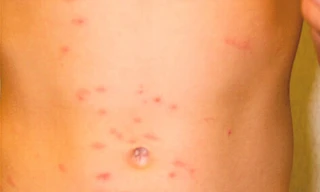 Ngứa do thời tiết rét nên đi khám chuyên khoa để được chỉ định dùng thuốc