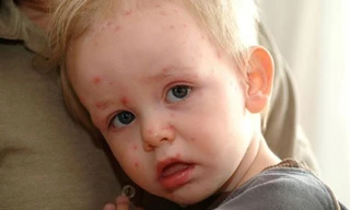 Thời tiết nắng nóng khiến trẻ bị rôm sảy.