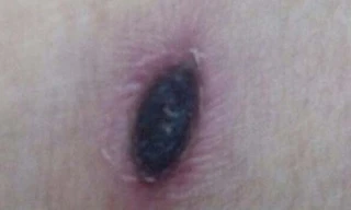 Vết đốt do côn trùng gây nên. Ảnh H.Hải