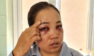 Chị Hằng với khuôn mặt bầm tím đang điệu trị tại bệnh viện