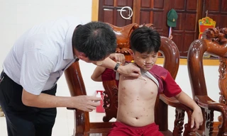 Quảng Bình: Ghi nhận ổ dịch thuỷ đậu 'khủng' trong trường học