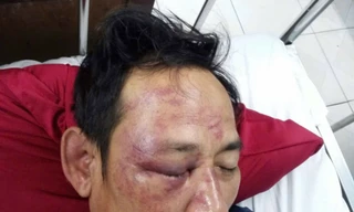 Vụ người đàn ông bị đánh ‘thập tử nhất sinh’ ở Quảng Bình: Nguyên nhân từ bài thơ đăng trên facebook 