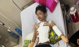 Nam sinh ở Quảng Bình mất bàn tay, tính mạng nguy kịch vì tự chế pháo nổ 