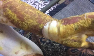 Hình ảnh vết bỏng của D.A.