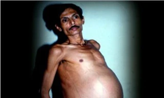 Kỳ lạ, người đàn ông mang thai suốt 36 năm