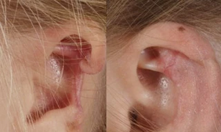 Mất một phần tai vì bị nhện cắn