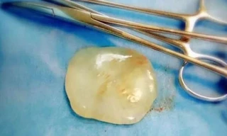 "Viên ngọc" rơi ra từ bụng sản phụ trong quá trình mổ đẻ ở Trung Quốc.