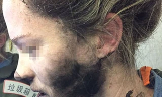 Nữ hành khách bị bỏng mặt, cháy xém tóc vì tai nghe chạy pin phát nổ trên máy bay.