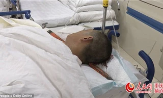 Anh Wang Long bị thanh thép lớn đâm xuyên qua đầu trong một vụ tai nạn lao động.