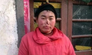 Cô gái bị chuột cắn đứt... mũi