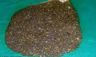 Hãi hùng phát hiện gần 12.000 viên sỏi trong bụng bệnh nhân