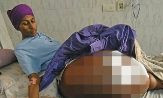 Gurmeet Singh mang trên người khối u khổng lồ suốt nhiều năm. Ảnh: Dailymail