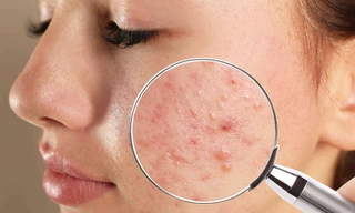 Xác định đúng loại "đèn pin" đang mắc phải sẽ giúp bạn điều trị mụn hiệu quả hơn