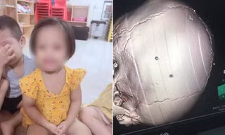 Gia đình bé gái bị đóng đinh vào đầu cho biết bé có sự chuyển biến rõ rệt về sức khỏe