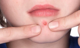 Nữ sinh 15 tuổi ở Hà Nội tử vong sau khi nặn mụn, bôi thuốc không rõ nguồn gốc