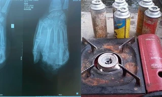 Nam sinh 14 tuổi ở Hải Dương gặp tai nạn phải đi cấp cứu khi đang ăn lẩu tại nhà