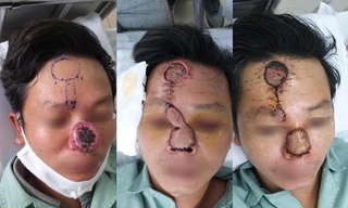 Kỳ diệu tái tạo mũi cho bệnh nhân ung thư bị xâm lấn đường thở