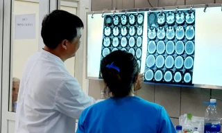 Lần đầu tiên Việt Nam ghi nhận ca xuất huyết não do ma tuý đá