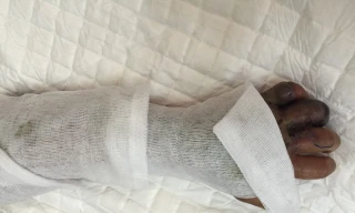 Bị rắn cắn, bé 10 tuổi hoại tử nặng vì đắp lá thuốc