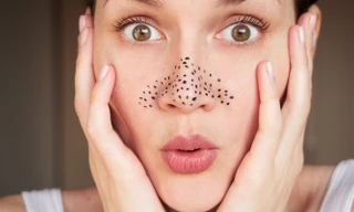 Thổi bay mụn đầu đen bằng những phương pháp gần như chẳng tốn xu nào