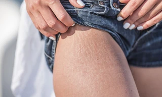 Rạn da tuổi dậy thì: Rắc rối ngoại hình khó nói thành lời của con gái 