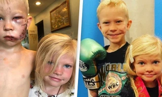 “Siêu anh hùng nhí" cứu em gái khỏi chó cắn được nhóm bác sĩ tình nguyện chữa sẹo miễn phí