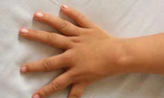 Tay 6 ngón bị từ chối thi bằng lái xe