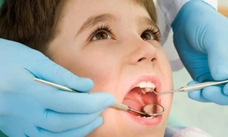 Có nên cắt amidan cho trẻ em?