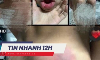 TIN NHANH 12H: Công an vào cuộc vụ cháu bé bị cô giáo đánh chảy máu miệng, sưng đầu