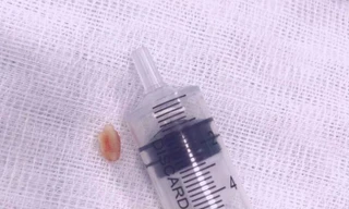 Hạt lạc mắc kẹt gần một tháng trong khí quản cháu bé 18 tháng tuổi