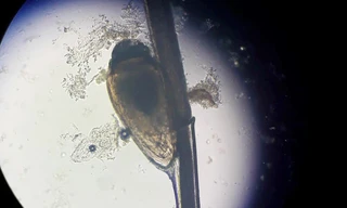 Rận ký sinh chi chít ở nách người đàn ông suốt 2 tháng