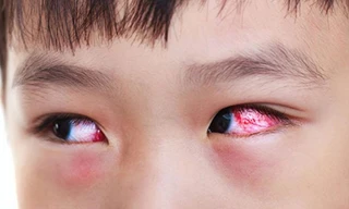 700 trẻ đau mắt đỏ nhập viện trong một tháng