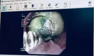 Sản phụ suýt mất mạng vì nuốt túi mật lợn