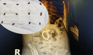 Nuốt 25 viên bi nam châm vào bụng, bé 3 tuổi bị thủng ruột, tá tràng