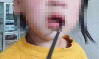 Bé gái 4 tuổi bị thanh sắt dài 20cm đâm vào khoang miệng 