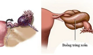 Bé gái hơn 1 tuổi ở Nghệ An phải cắt bỏ buồng trứng 