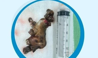 Sỏi san hô ‘lấp kín’ thận người đàn ông 58 tuổi ở Nghệ An