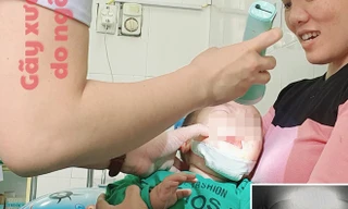 Ngã xe đẩy, bé 10 tháng tuổi bị gãy xương hàm