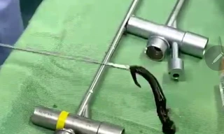 Kinh hãi vắt rừng căng máu ký sinh trong đường thở bé 6 tuổi