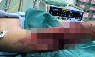  Bé 7 tuổi ngã gãy tay do áo chống nắng cuốn vào xích xe máy