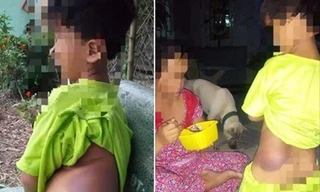 Vết thương trên cơ thể K nghi do cô giáo đánh