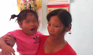 Cháu N.T.H.Y bị méo miệng đang được điều trị