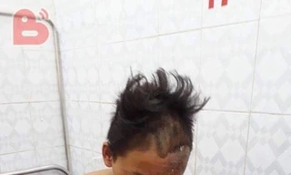 Thiếu niên 15 tuổi bị sét đánh cháy xém nửa người