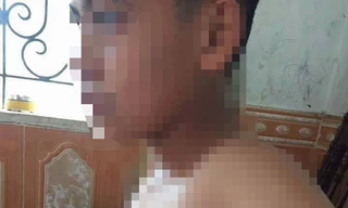 Phụ huynh xông vào trường đánh học sinh lớp 7 bầm tím sườn