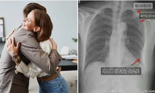 Bị đồng nghiệp ôm chào hỏi mạnh đến mức gãy luôn 3 xương sườn, cô gái Trung Quốc khởi kiện