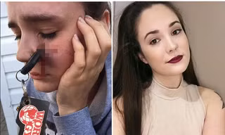 Cô gái bị chìa khóa ô tô ghim vào mặt chỉ vì bắt trượt chùm chìa khóa bạn ném cho