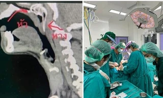 Đang câu cá thì bị cá nhảy luôn vào họng, một người Thái Lan phải phẫu thuật khẩn cấp