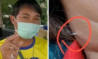 Hóc xương cá nhưng mặc kệ, một người bị cái xương xuyên qua da, “ló” ra ngoài