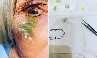 Bệnh nhân “để quên” 23 chiếc kính áp tròng trong một bên mắt, đến bác sĩ cũng choáng váng