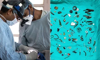 Bệnh nhân kêu đau bụng, bác sĩ khám phát hiện có 60 món đồ bị nuốt vào trong bụng